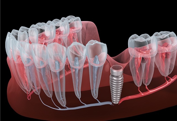 치조골 내부에 임플란트 식립 과정을 보여주는 3D 일러스트