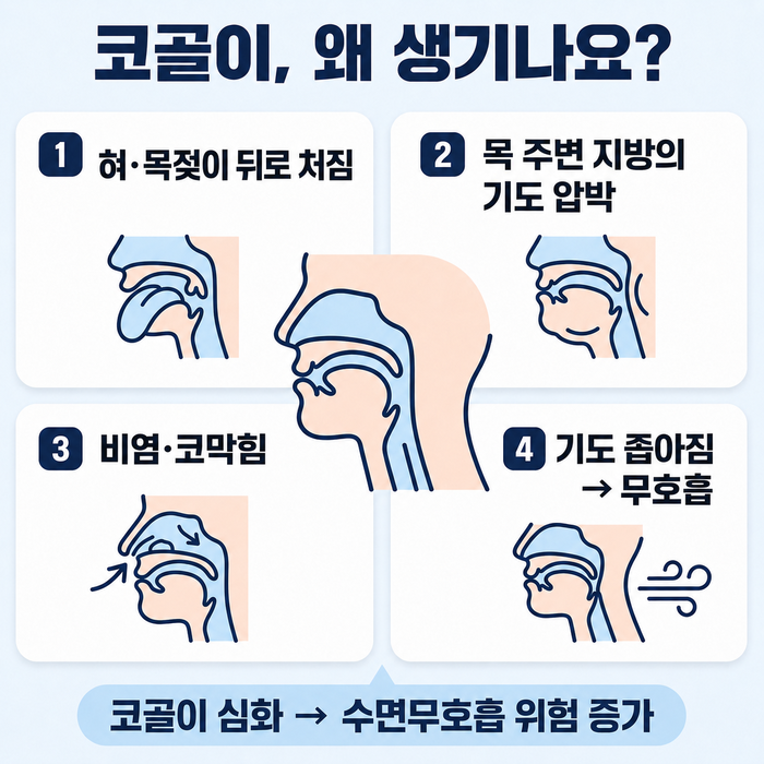 코골이 발생 원인과 기도 구조 설명 이미지