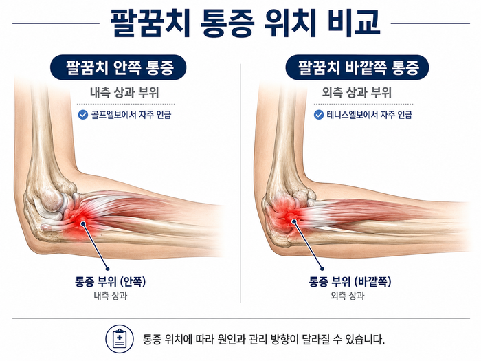 골프엘보와 테니스엘보의 차이를 설명하는 팔 그림