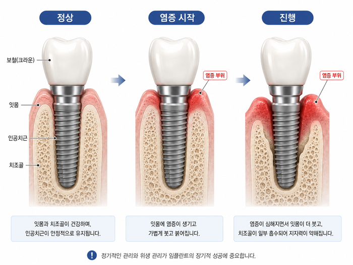 임플란트 재식립의 필요성과 원인에 대해 설명하는 치과 관련 이미지