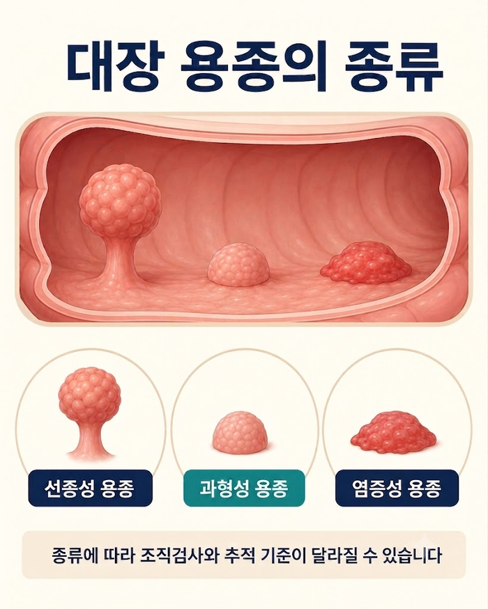 대장 용종의 종류를 설명하는 안내 이미지