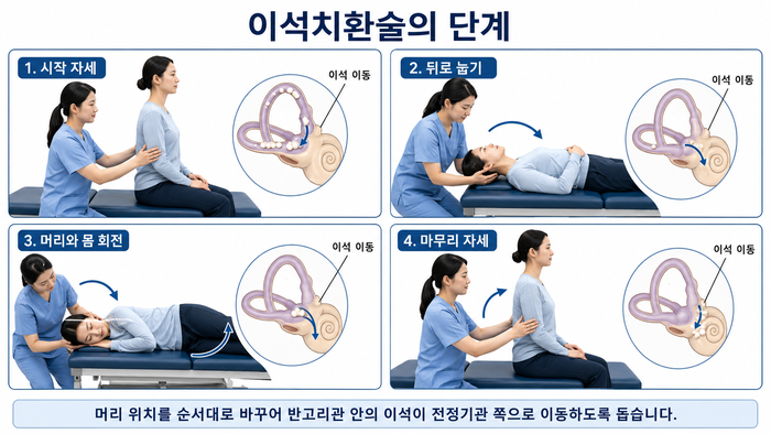 이석치환술의 머리와 몸의 움직임을 설명하는 그림