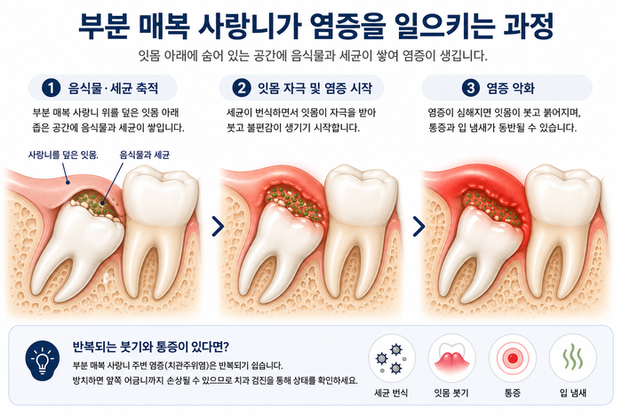부분 매복 사랑니 주변 잇몸 염증과 세균 축적을 보여주는 그림