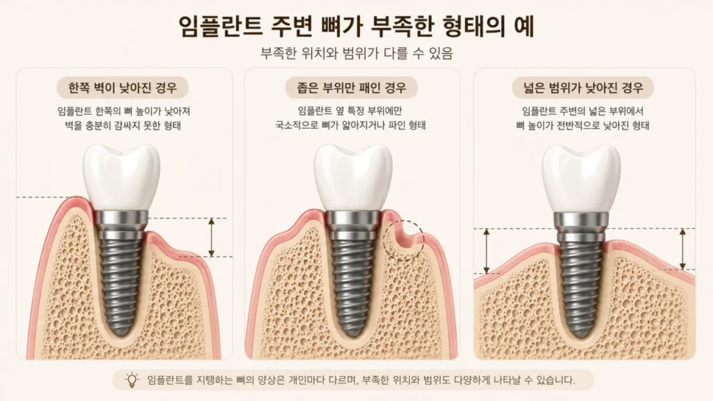 implant-bone-defect-patterns