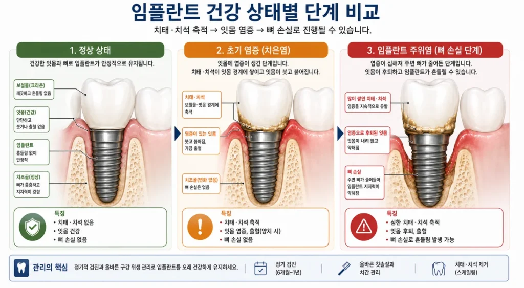 임플란트 오래 쓰려면 어떻게 관리해야 할까?