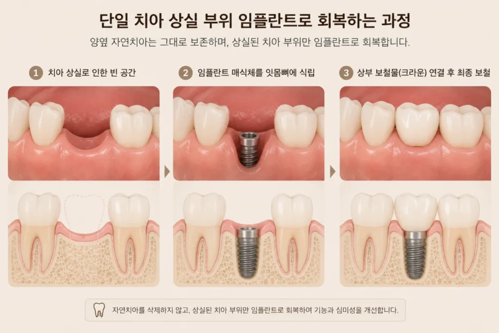 implant-role-single-tooth-restoration