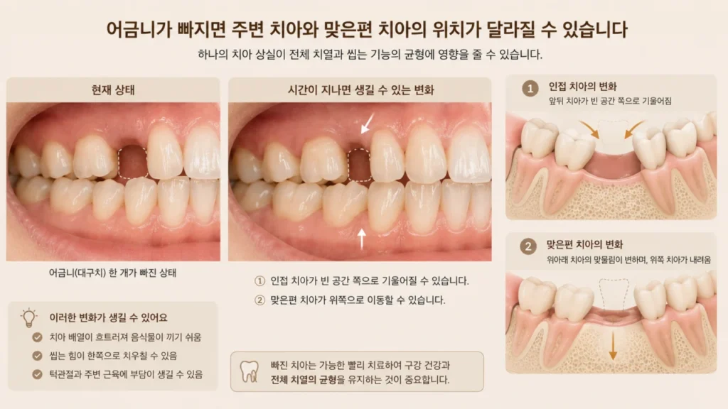 [임플란트 순서 1편] 치아를 하나 잃었는데 꼭 치료해야 할까? 임플란트가 필요한 이유