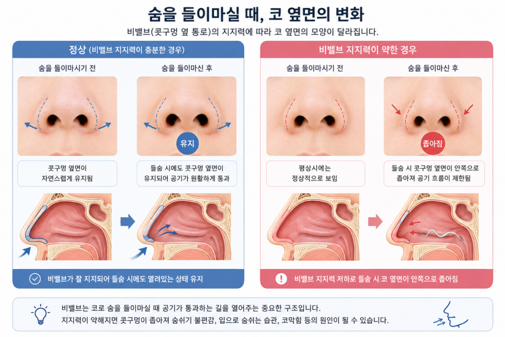 숨을 들이마실 때 코 옆면이 안쪽으로 들어가는 비밸브 협착 설명 이미지
