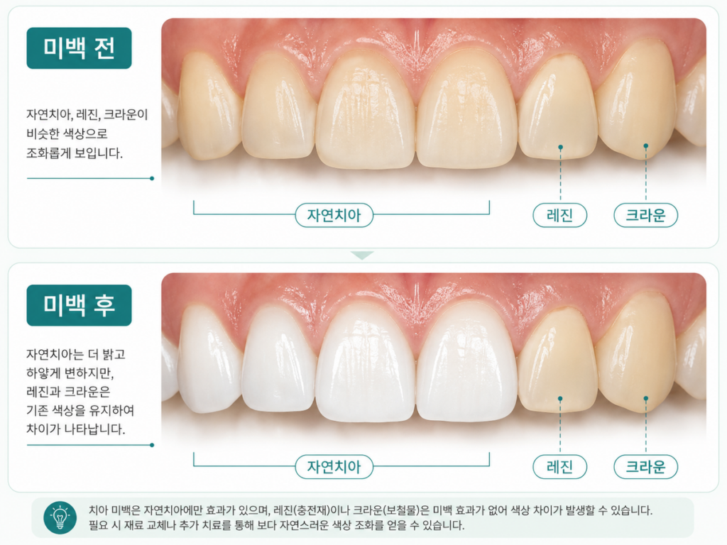 자연치아와 보철물의 미백 차이를 보여주는 그림