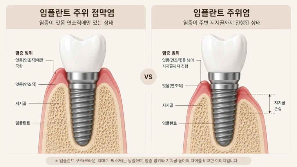 임플란트 점막염과 주위염의 차이를 설명하는 그림
