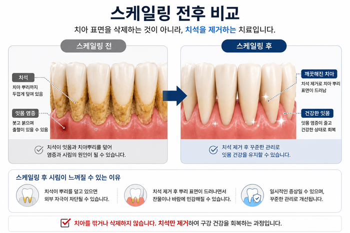 스케일링 후 치아 표면이 노출되어 시림이 발생하는 원리를 설명하는 그림