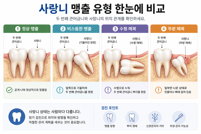 사랑니 맹출 방향과 턱뼈 공간에 따른 다양한 사랑니 위치 그림