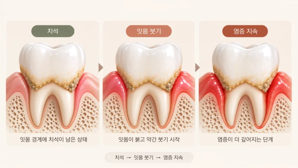 calculus-gum-inflammation-progression-1