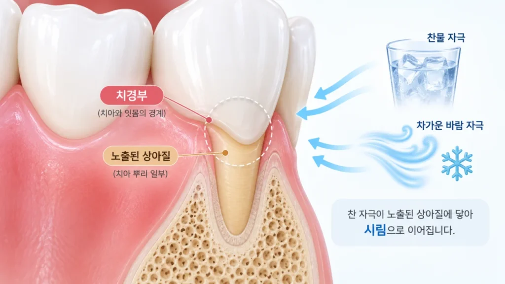 치아 잇몸 경계가 파이고 시린 이유는? 잇몸 파임 원인과 관리법