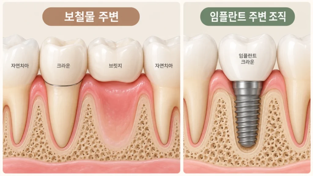 보철물과 임플란트 치료 후 주변 조직 관리의 중요성을 보여주는 그림