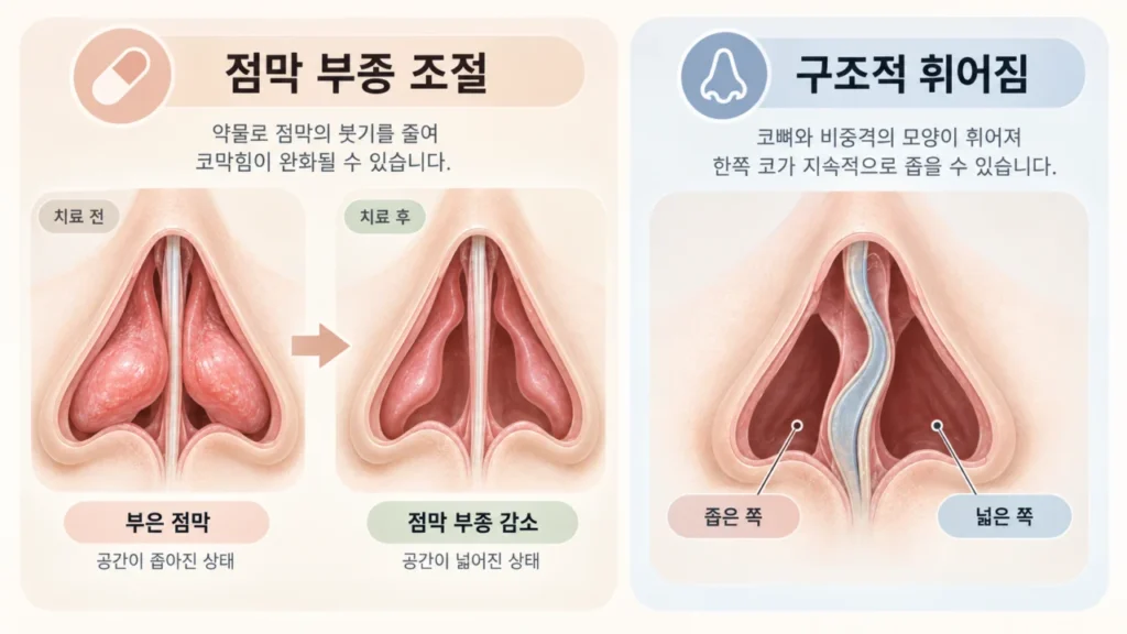 약물치료와 구조적 협착의 차이를 보여주는 비중격만곡증 관련 이미지