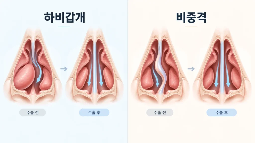 하비갑개 축소술과 비중격교정술의 차이를 설명하는 그림