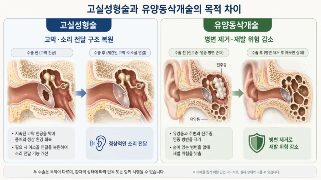 고실성형술과 유양동삭개술의 목적과 차이를 비교 설명하는 그림