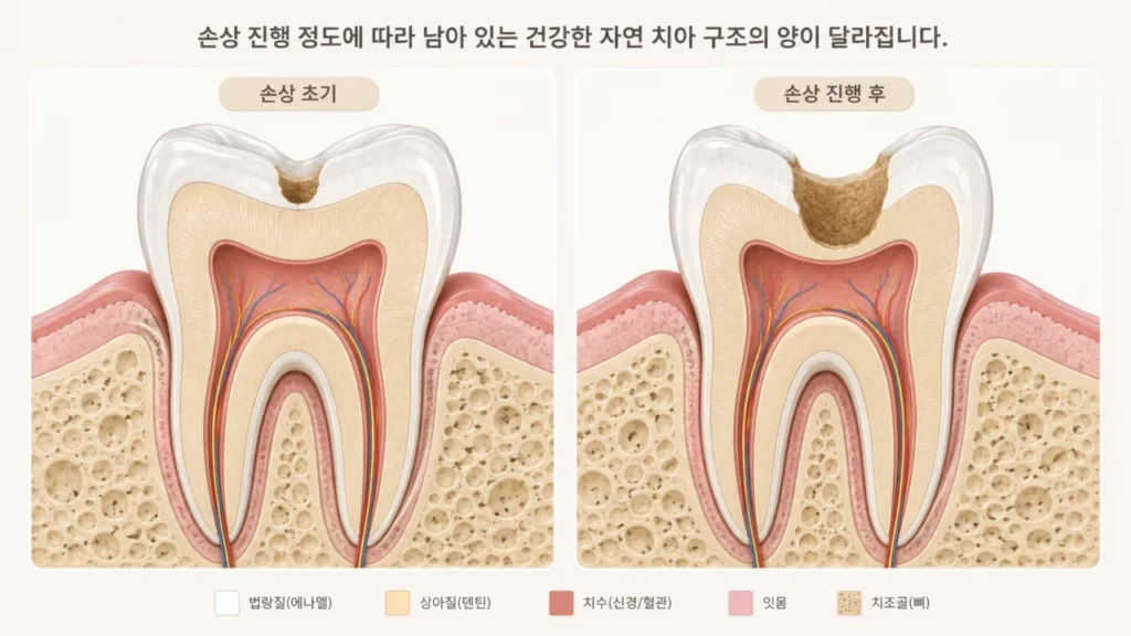 [충치 타이밍 4편] 충치 치료를 오래 미루면 어떻게 될까? 자연치아를 지키는 치료 시기