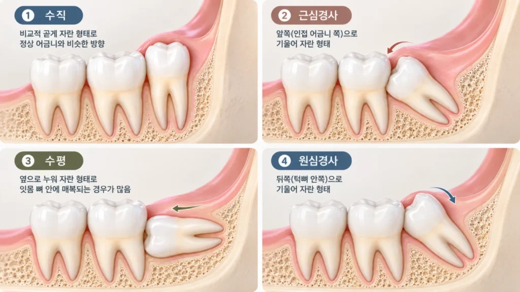 wisdom-tooth-angulation-comparison