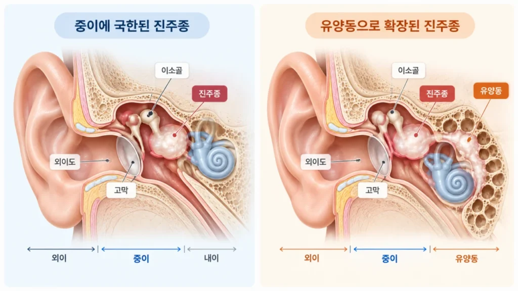 진주종이나 만성 염증이 유양동까지 확장된 경우의 수술 범위 그림