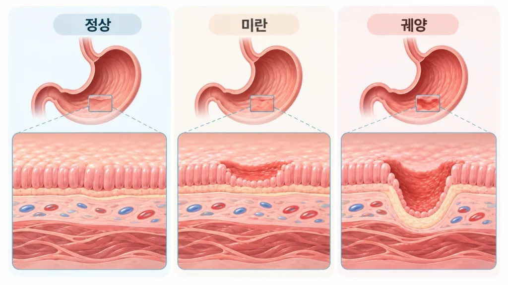 미란과 궤양의 점막 손상 깊이 차이를 보여주는 그림