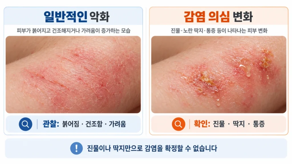 소아 아토피피부염에서 진물과 딱지, 감염 의심 신호를 보여주는 그림