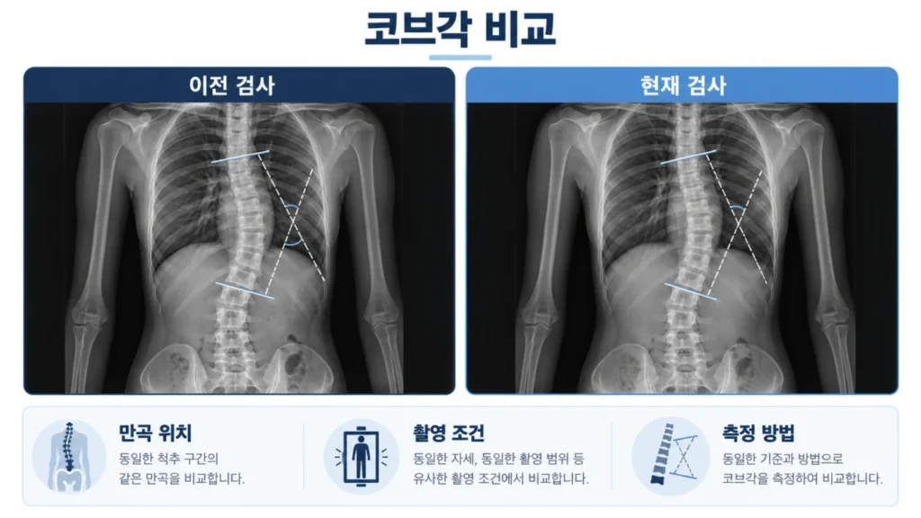 코브각 측정에서 과거와 현재 척추 만곡을 비교하는 이미지