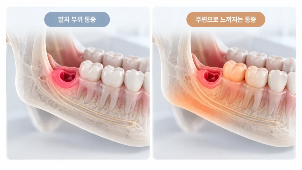 발치 부위에 집중되는 통증과 앞쪽 어금니, 턱 주변으로 퍼지는 통증의 차이를 설명하는 그림